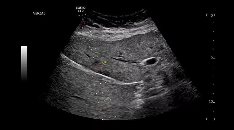 logiq-e10-ge-ultrasound_clinical_case03