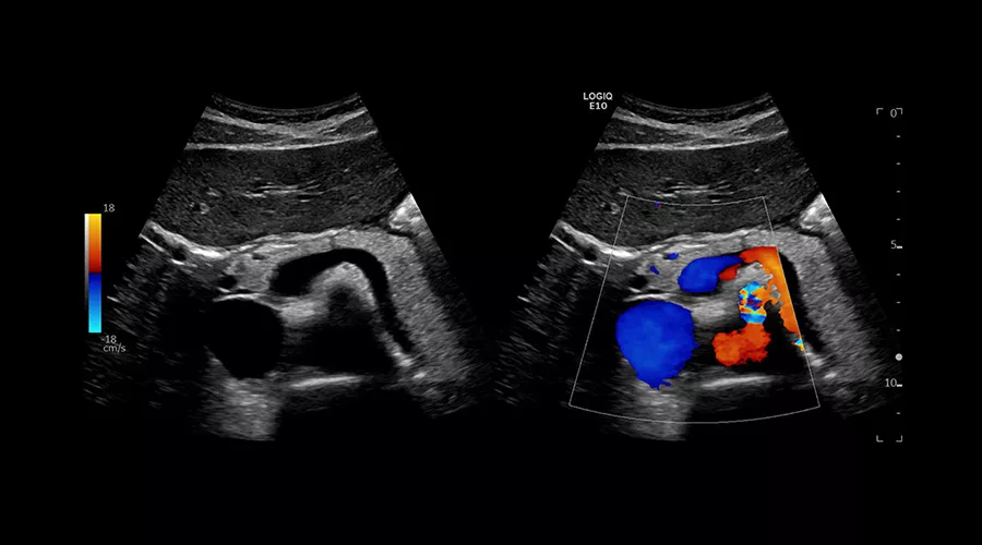 logiq-e10-ge-ultrasound_clinical_case05