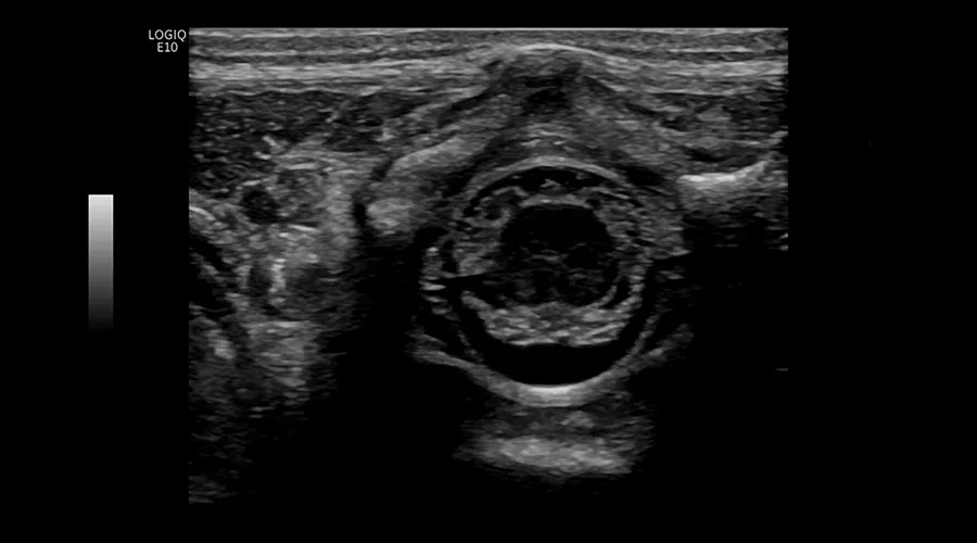 logiq-e10-ge-ultrasound_clinical_case07