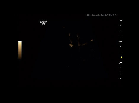 B-Flow Imaging on LOGIQ P9