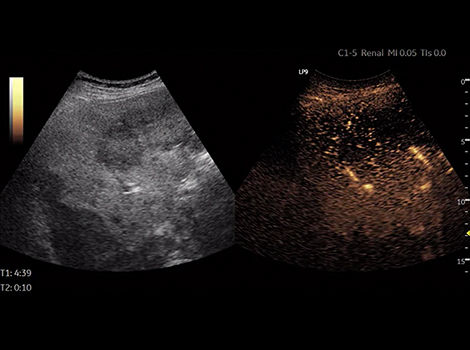 Contrast Enhanced Ultrasound CEUS on LOGIQ P9