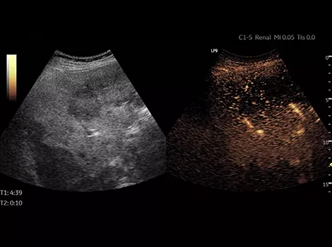 Contrast Enhanced Ultrasound CEUS on LOGIQ P9