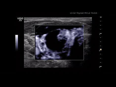 Small vessel imaging with HD Color on LOGIQ P9
