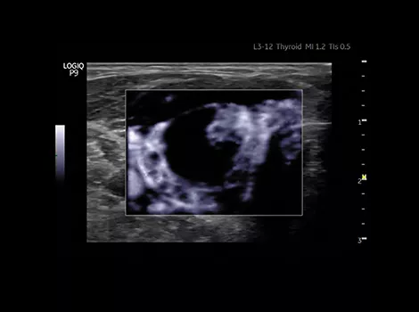 Small vessel imaging with HD Color on LOGIQ P9