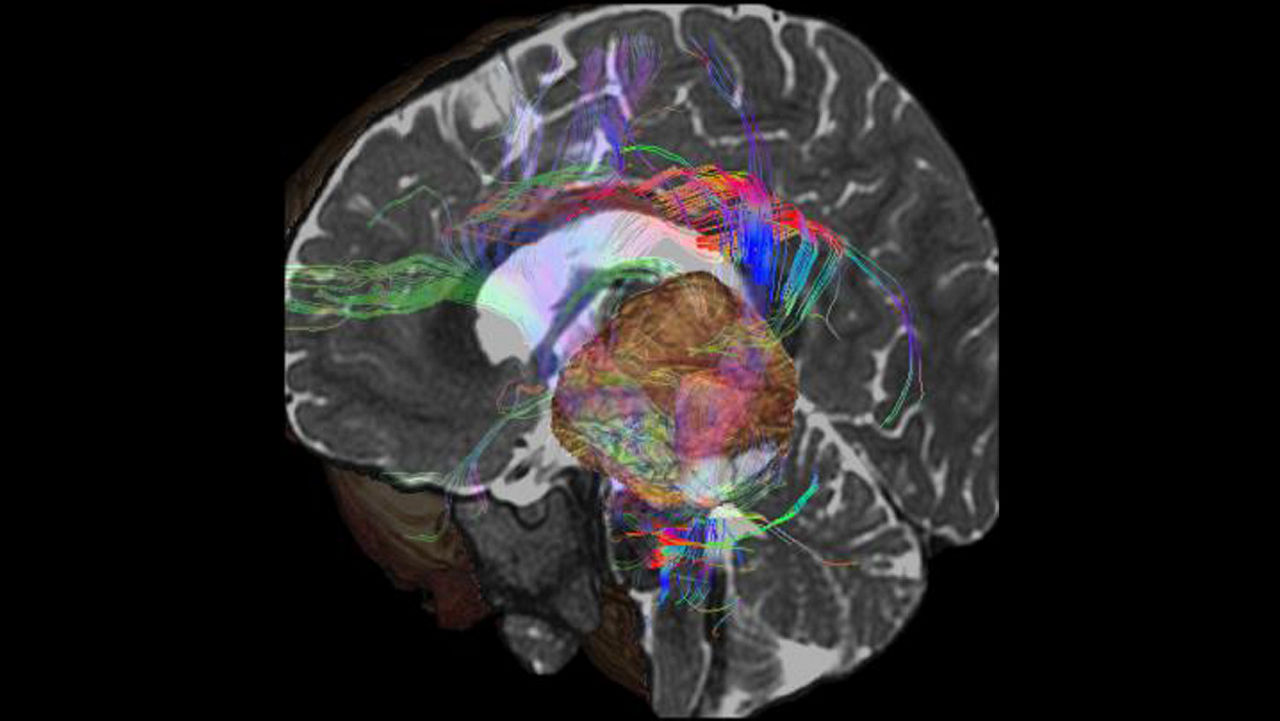 lone-advanced-visualization-applications-brain-view-plus-aw-brainview-clinical-image-1