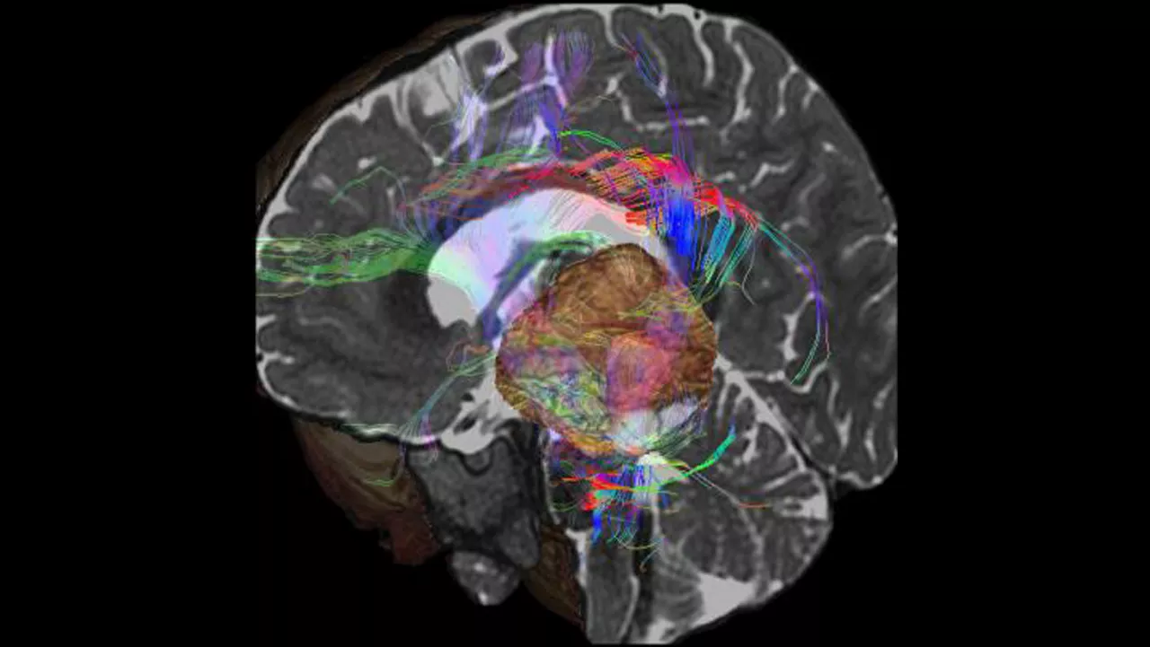 lone-advanced-visualization-applications-brain-view-plus-aw-brainview-clinical-image-1