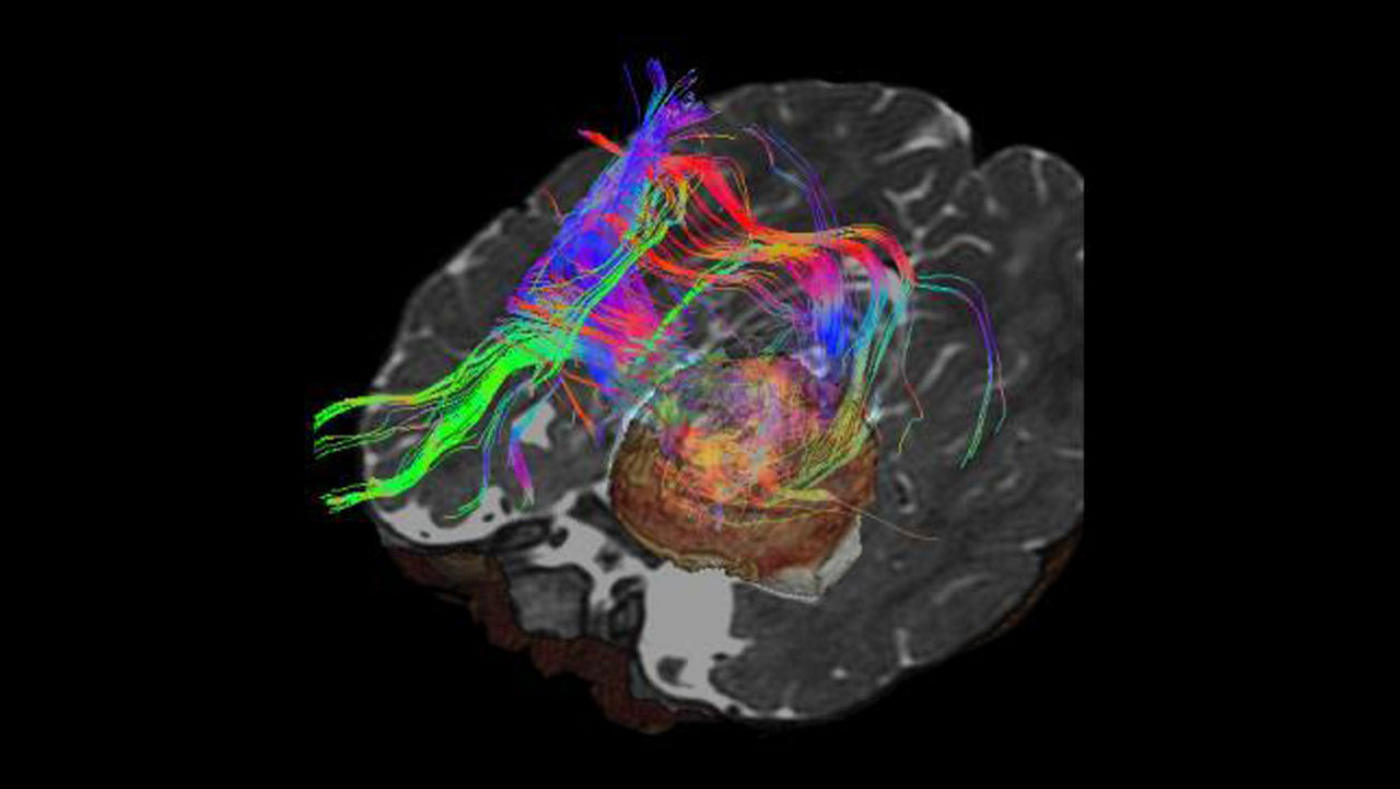 lone-advanced-visualization-applications-brain-view-plus-aw-brainview-clinical-image-2
