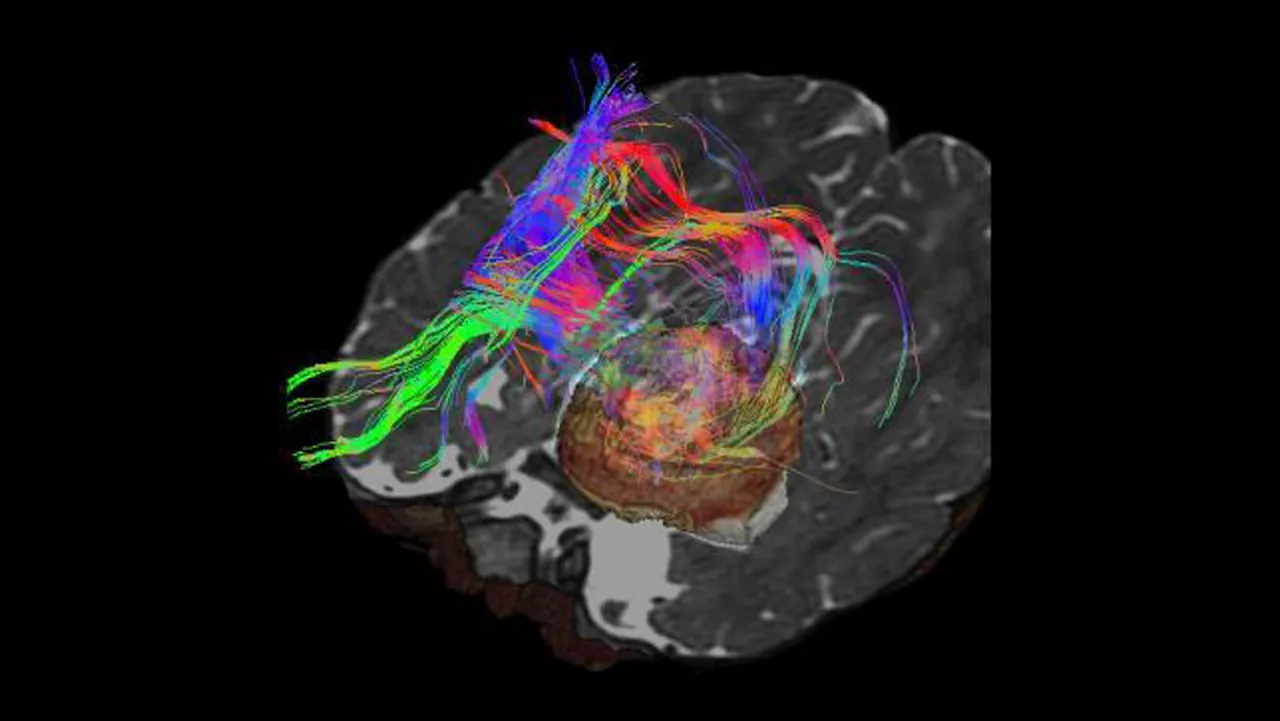 lone-advanced-visualization-applications-brain-view-plus-aw-brainview-clinical-image-2