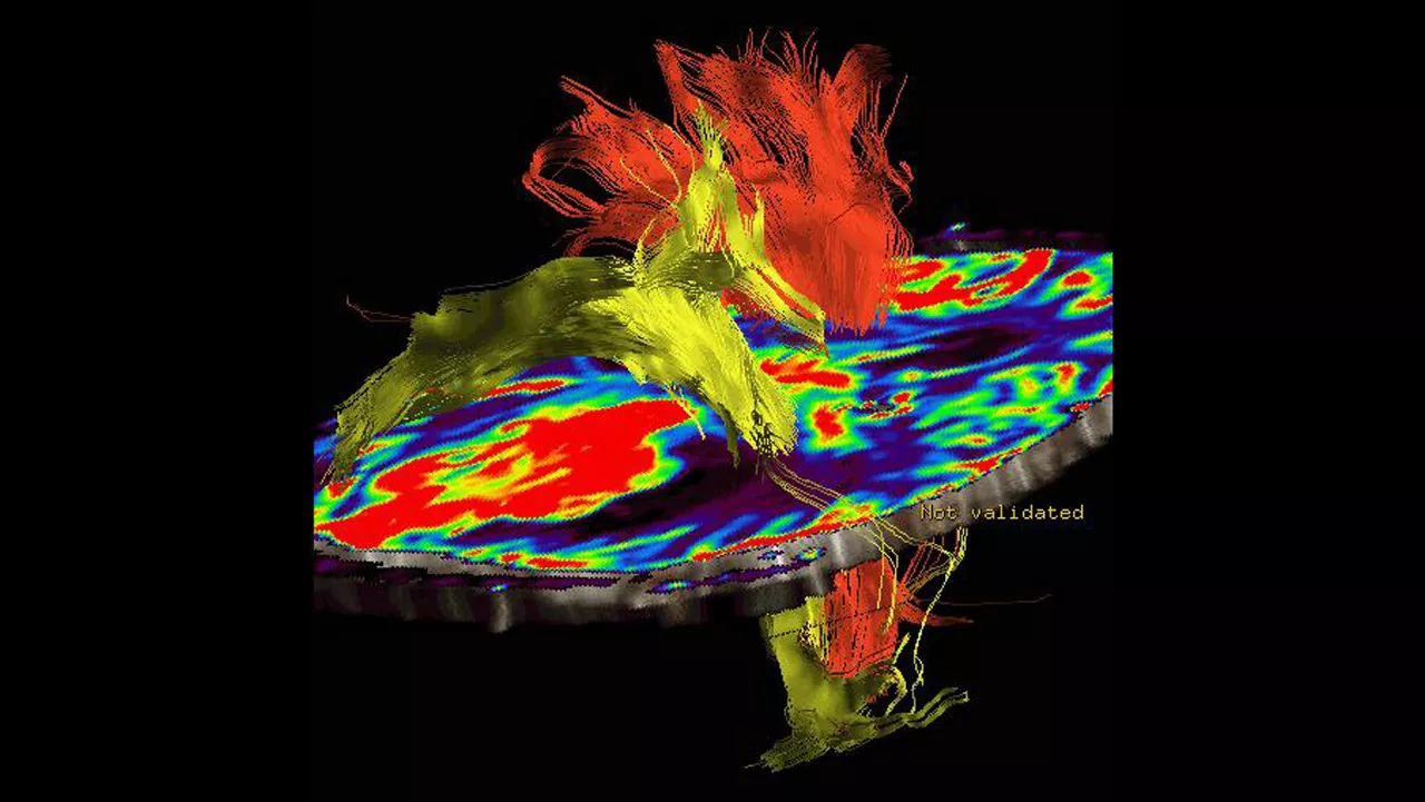 lone-advanced-visualization-applications-brain-view-plus-aw-brainview-clinical-image-3
