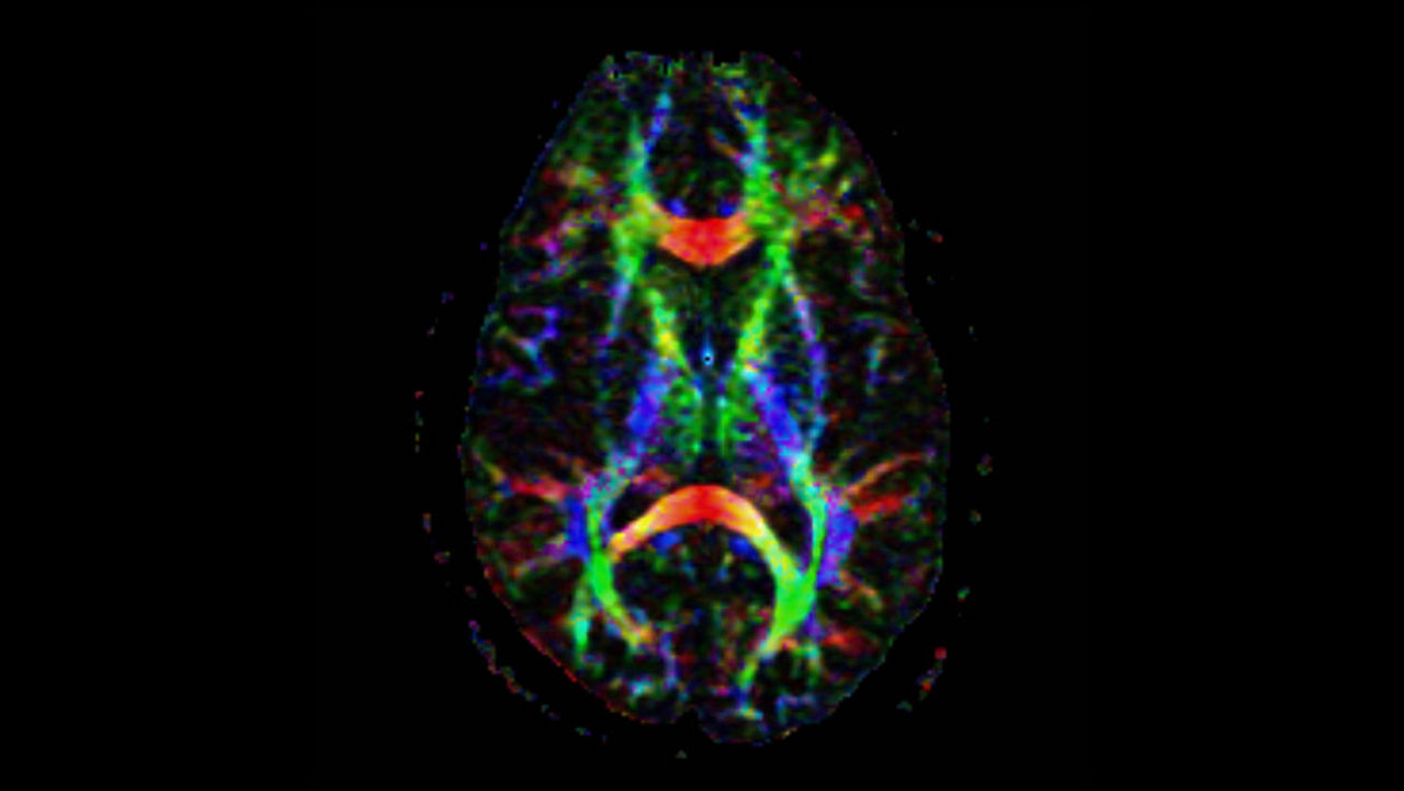 lone-advanced-visualization-applications-brain-view-plus-aw-brainview-clinical-image-4