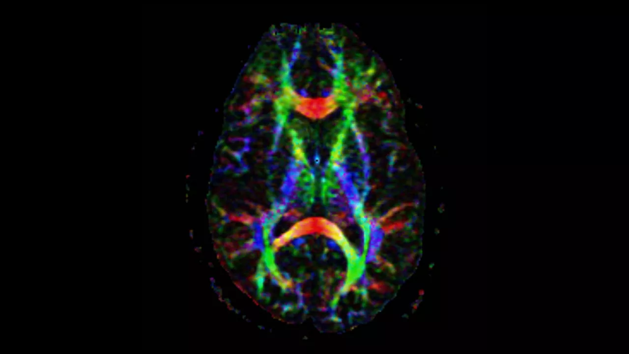 lone-advanced-visualization-applications-brain-view-plus-aw-brainview-clinical-image-4