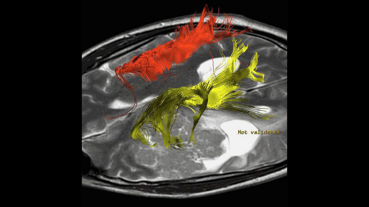 lone-advanced-visualization-applications-brain-view-plus-aw-brainview-clinical-image-5