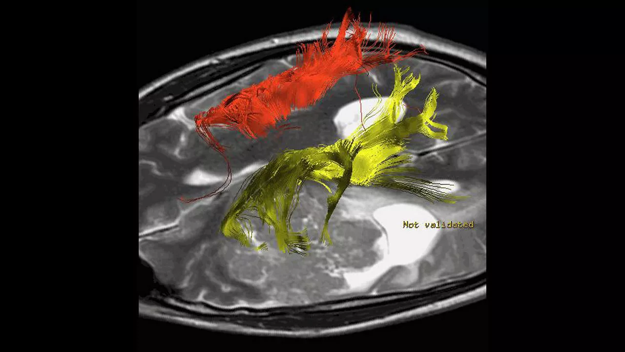lone-advanced-visualization-applications-brain-view-plus-aw-brainview-clinical-image-5