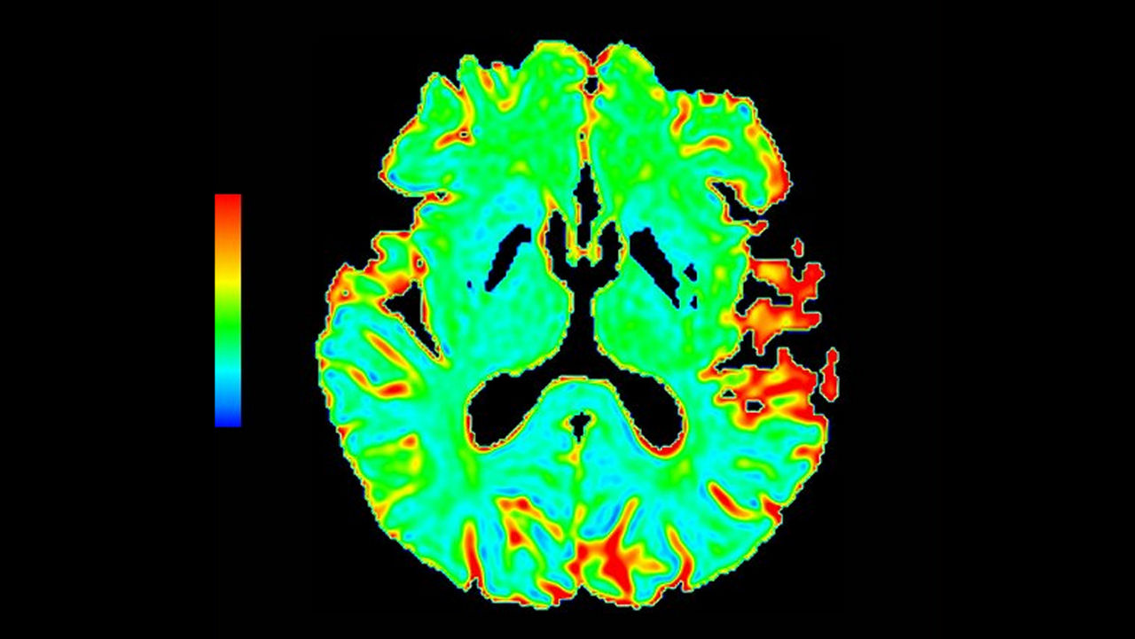 lone-advanced-visualization-applications-brain-view-plus-aw-brainview-clinical-image-6