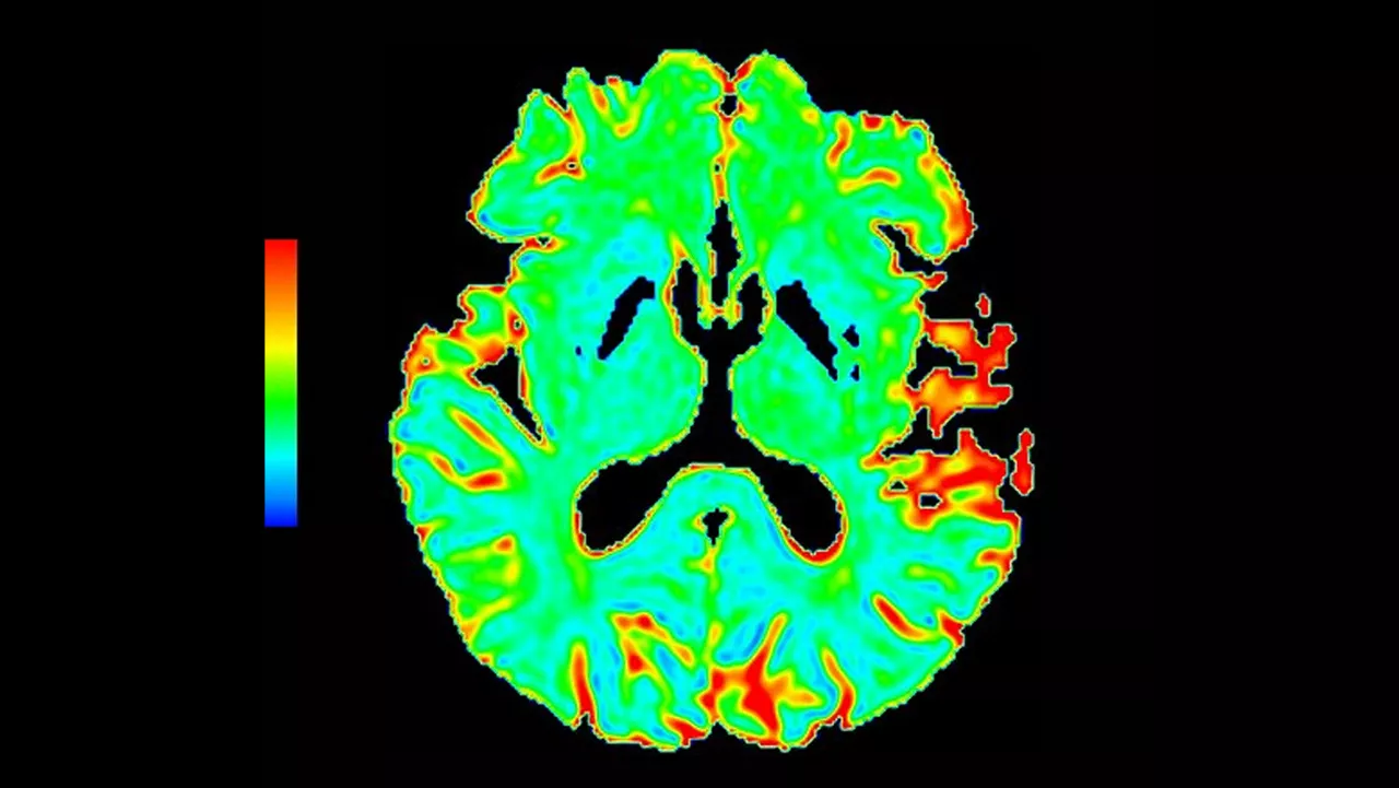 lone-advanced-visualization-applications-brain-view-plus-aw-brainview-clinical-image-6
