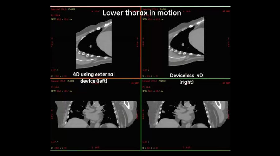 Lower thorax in motion