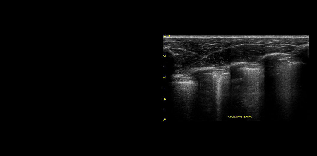 Lung-sweep-e-Consolidation-desktop