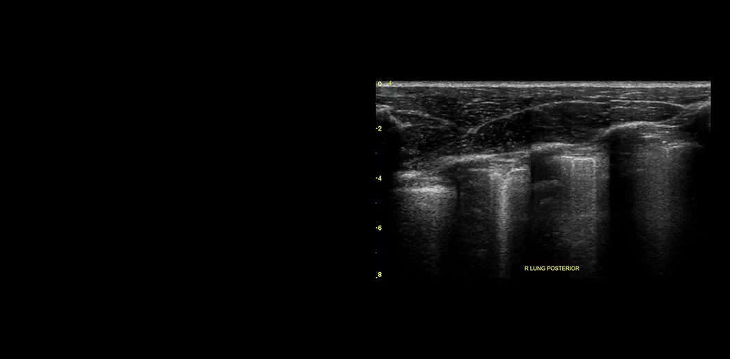 Lung-sweep-e-Consolidation-desktop