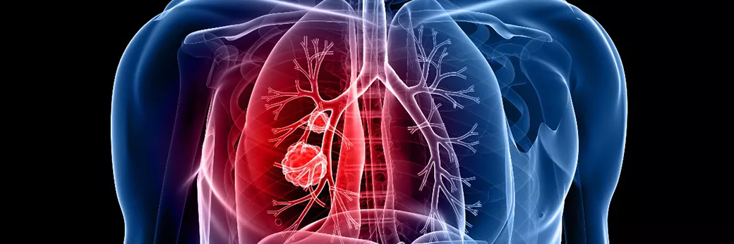 lung cancer - img