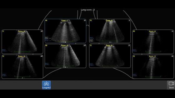 GE-Venue-Fit-LUSS in one view  Lung Diagram