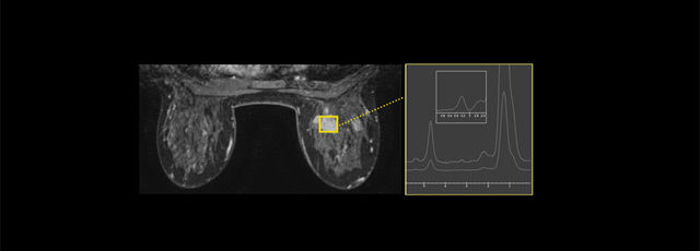 magnetic-resonance-imaging-breast-imaging-brease-brease-spotlight-mobile
