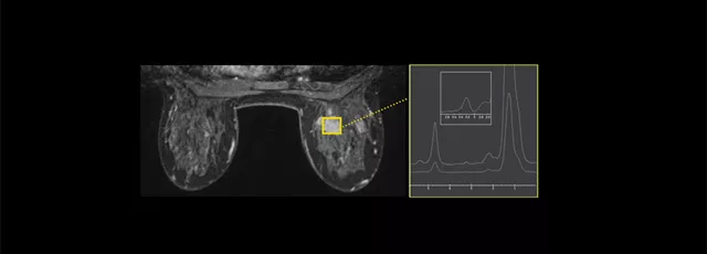 magnetic-resonance-imaging-breast-imaging-brease-brease-spotlight-mobile