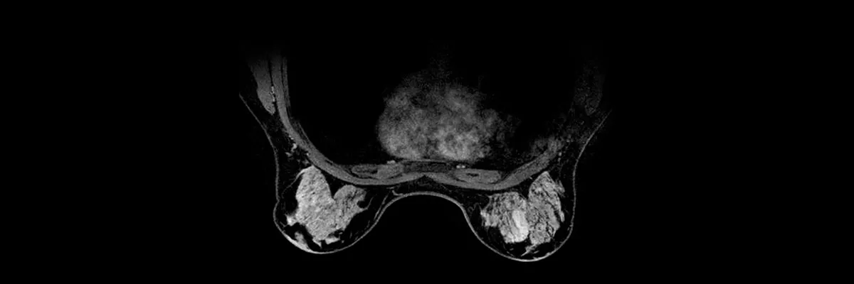 magnetic-resonance-imaging-breast-imaging-vibrant-hero