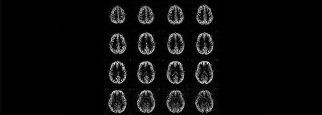 magnetic-resonance-imaging-pediatric-imaging-ped-3d-asl-mobile
