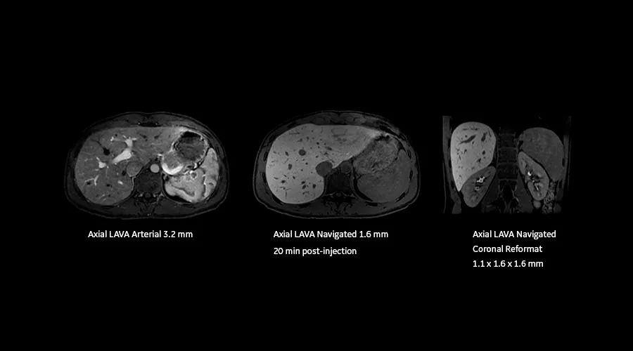 magnetic-resonance-imaging-signapremier-BodyWorks2