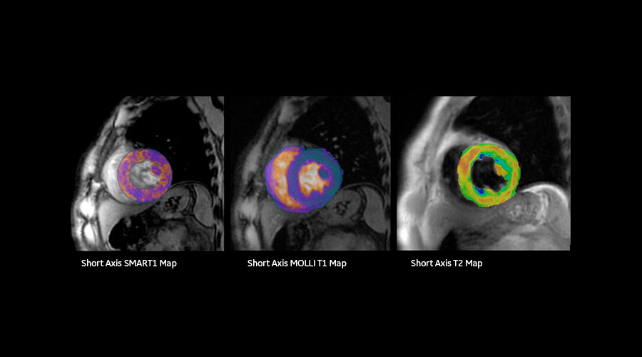 magnetic-resonance-imaging-signapremier-CVWorks1