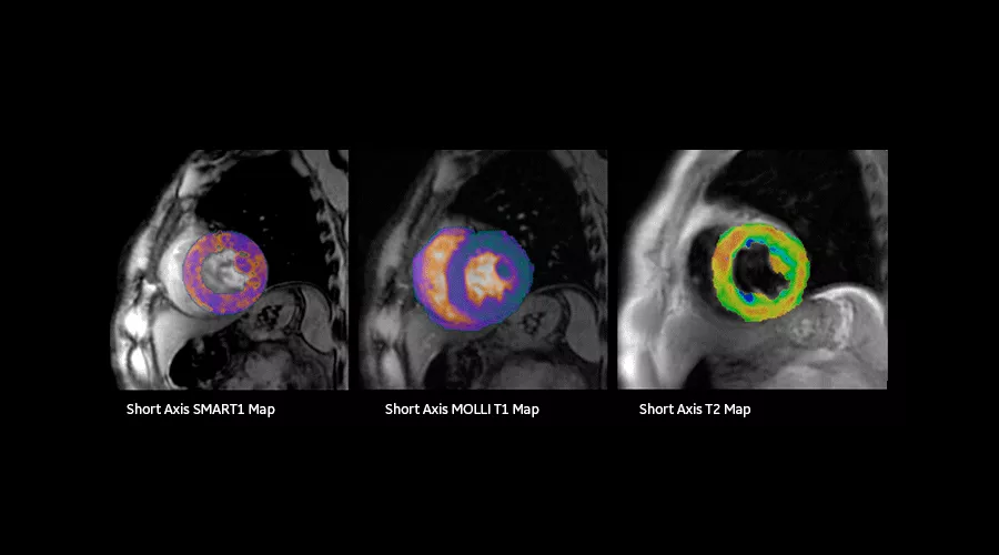 magnetic-resonance-imaging-signapremier-CVWorks1