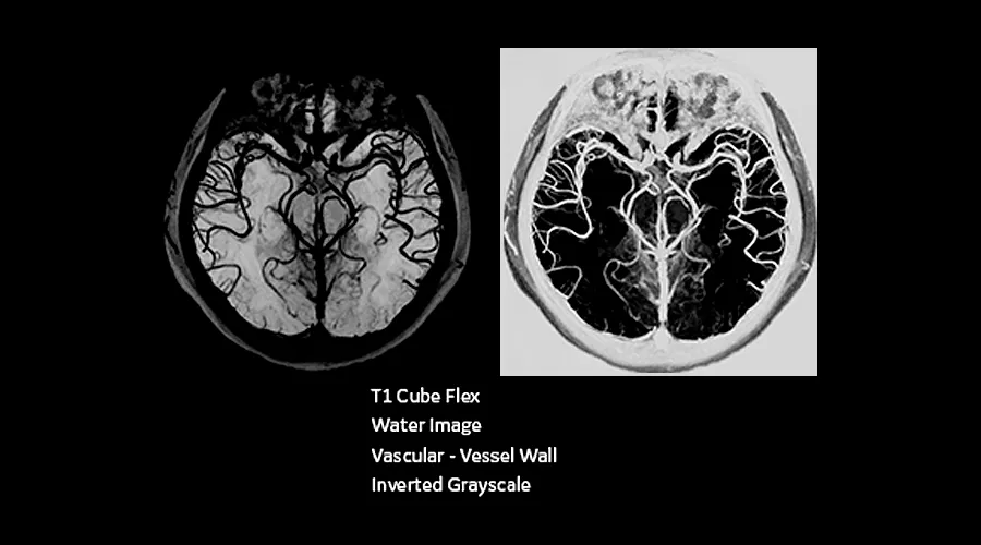 magnetic-resonance-imaging-signapremier-NeuroWorks1