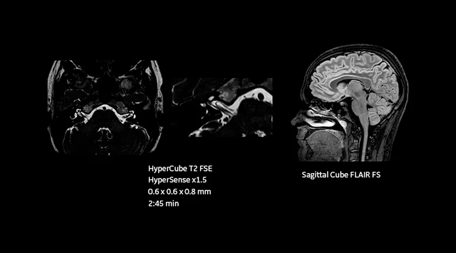 magnetic-resonance-imaging-signapremier-NeuroWorks2