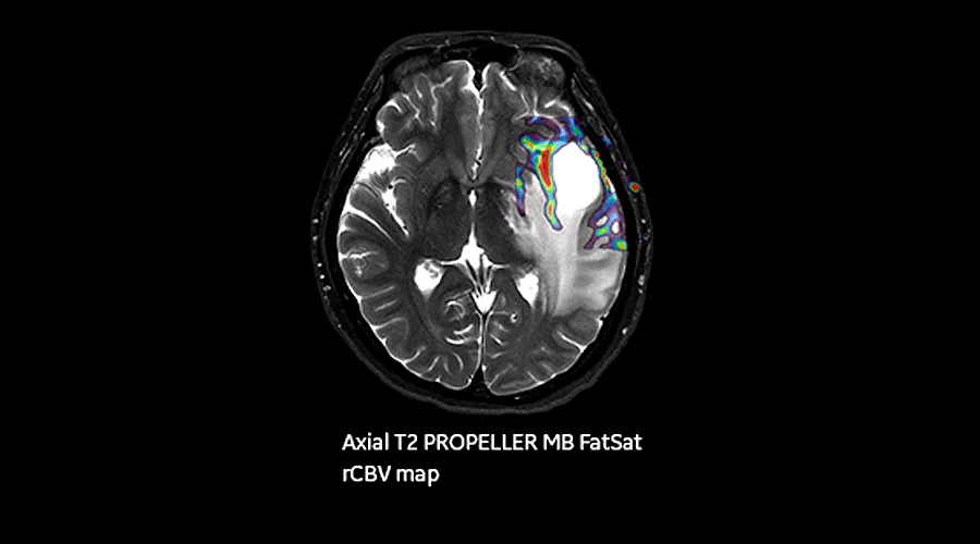 magnetic-resonance-imaging-signapremier-NeuroWorks3