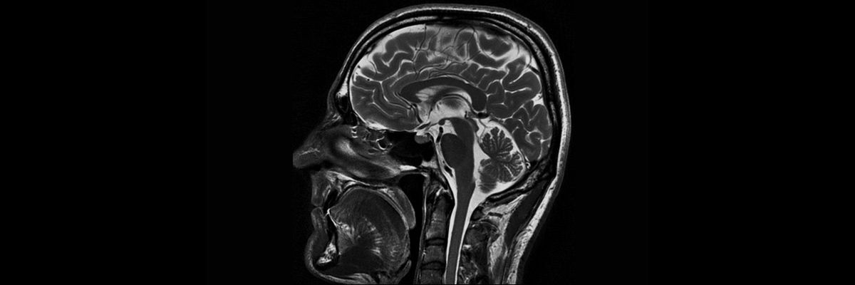 magneticresonanceimagingneuroimaginggehcmagneticresonanceneurot2propellersag
