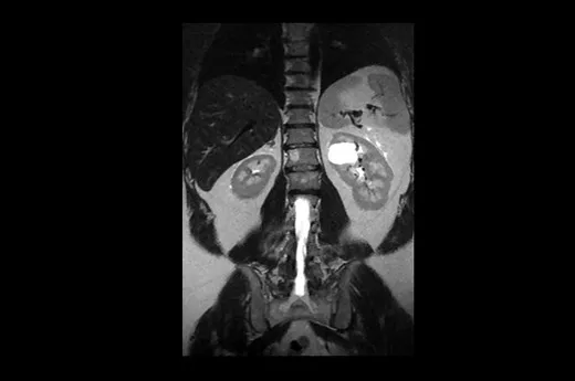 magneticresonanceimagingsigna20artistCoronalT2SSFSE