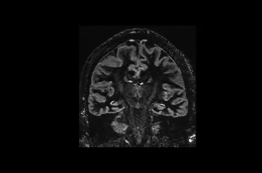 magneticresonanceimagingsigna20artistSagittal3DCubeDIRCoronalReformat