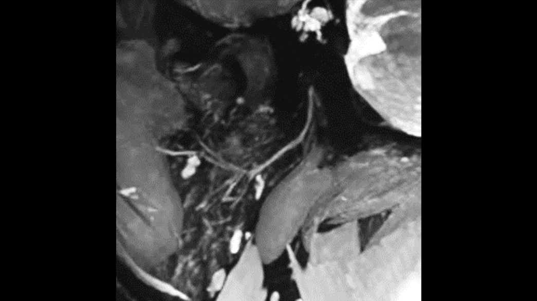 MENSA-Nerve1040-x-585