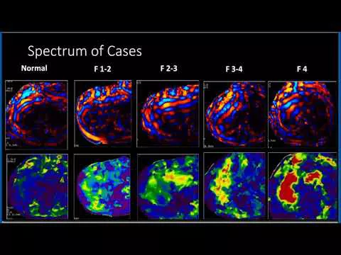 MR Elastography
