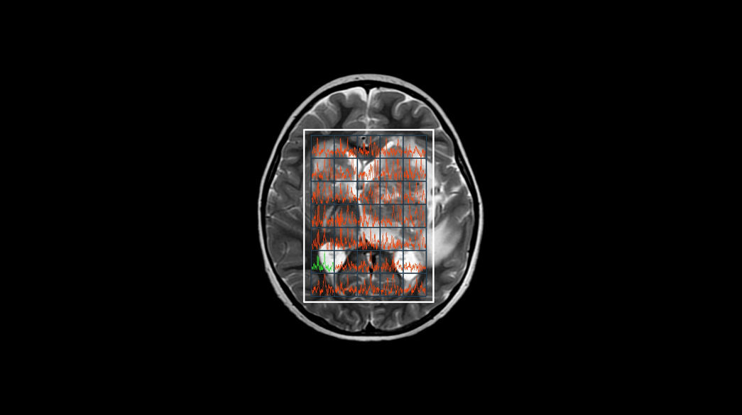 MR-Spectroscopy1040-x-585