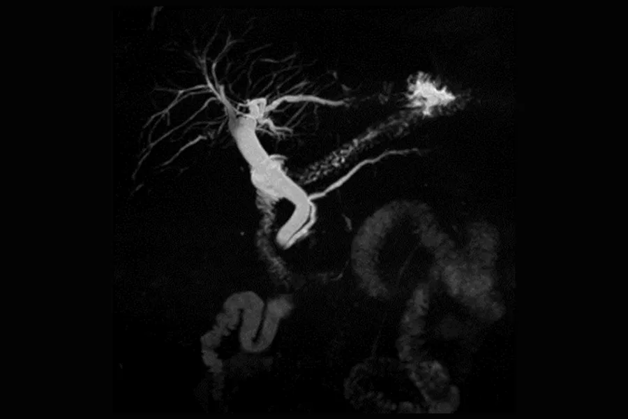 MRCP