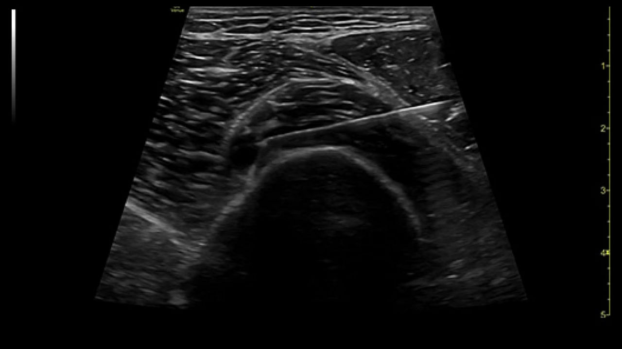 musculoskeletal-needle-mode-ci-en