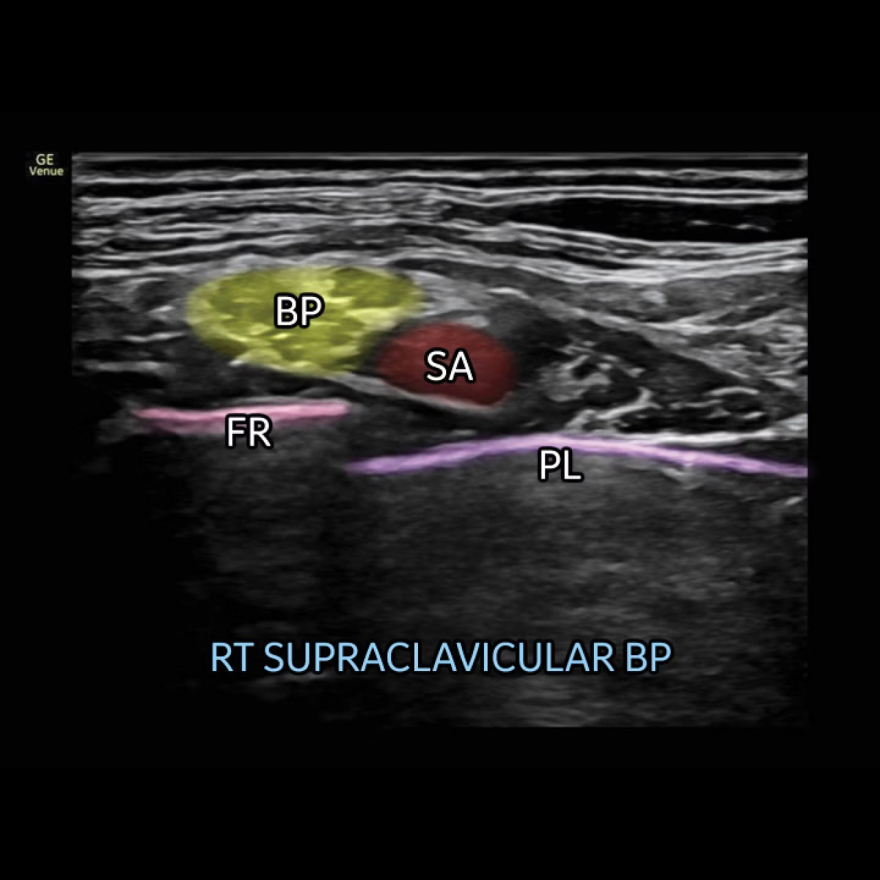 musculoskeletal-nerveblox-ci-en