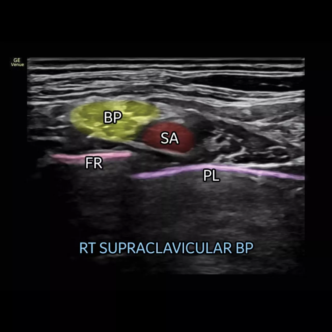 musculoskeletal-nerveblox-ci-en
