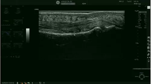 Musculosketal