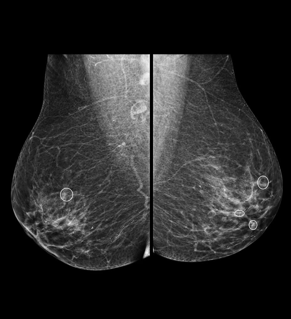 MyBreastAiSuite_feature03