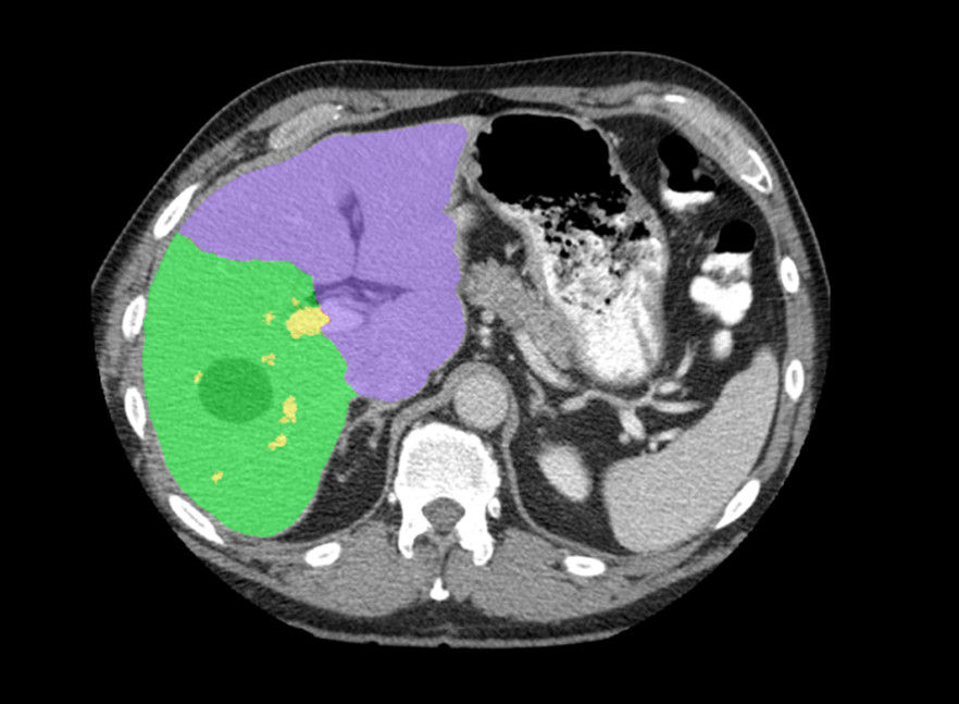 nced-visualization-applications-hepatic-vcar-image-gallery-aw-hepatic-vcar-hvcar-axial_jpg