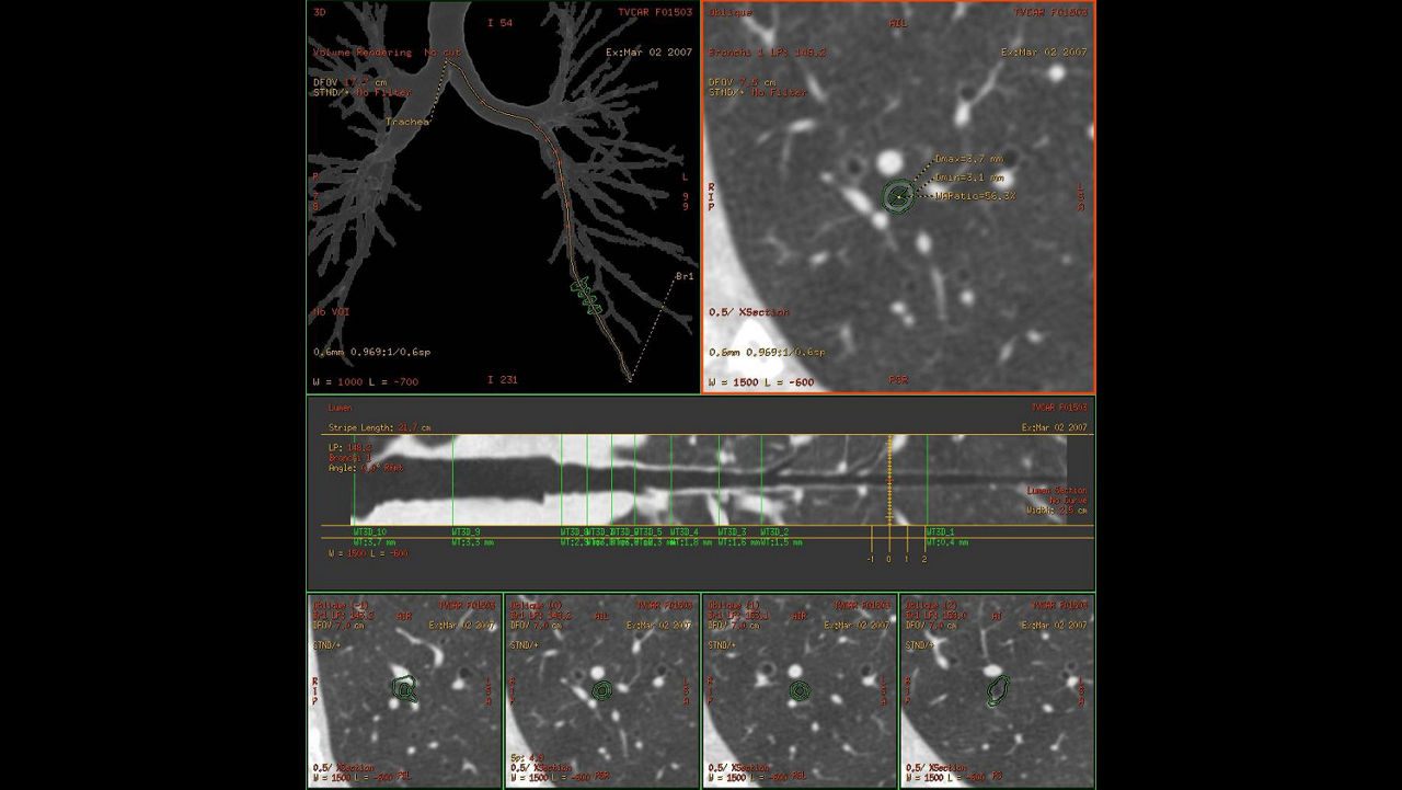 nced-visualization-applications-thoracic-vcar-image-gallery-aw-thoracic-vcar-clinical1