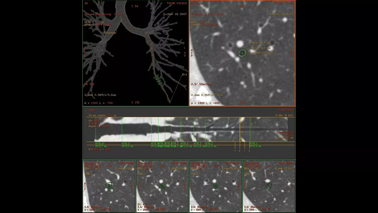 nced-visualization-applications-thoracic-vcar-image-gallery-aw-thoracic-vcar-clinical1