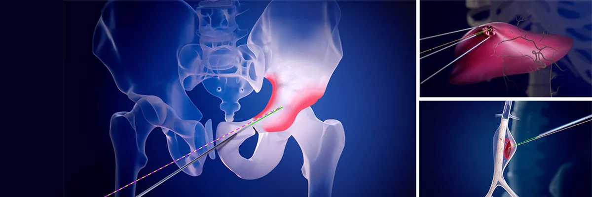 needle-assist-image-ba-en